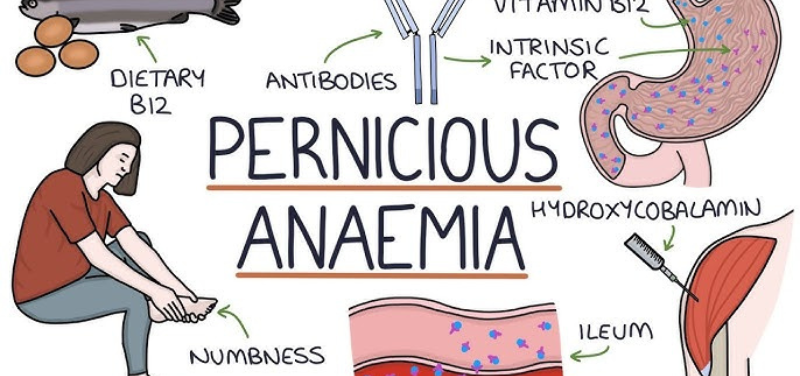 Pernicious Anaemia
